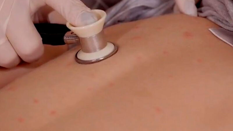 Sube a 31 cifra de muertes por sarampión en México